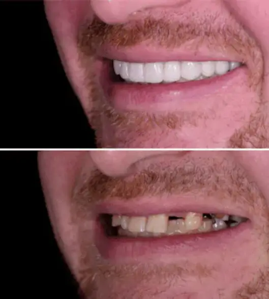 Dental Implants Smile in Midlothian, TX