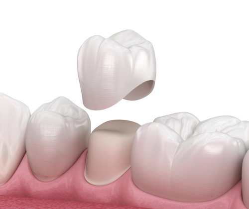  Illustration of a dental crown similar to what our dentist in Midlothian creates