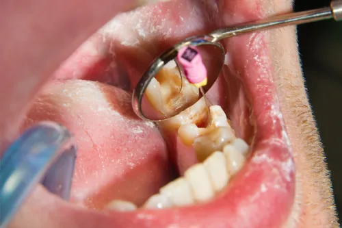 A example of a root canal